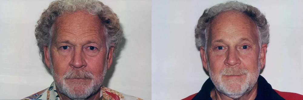 Real patient results in Newport Beach, CA Performed by Boris M. Ackerman MD