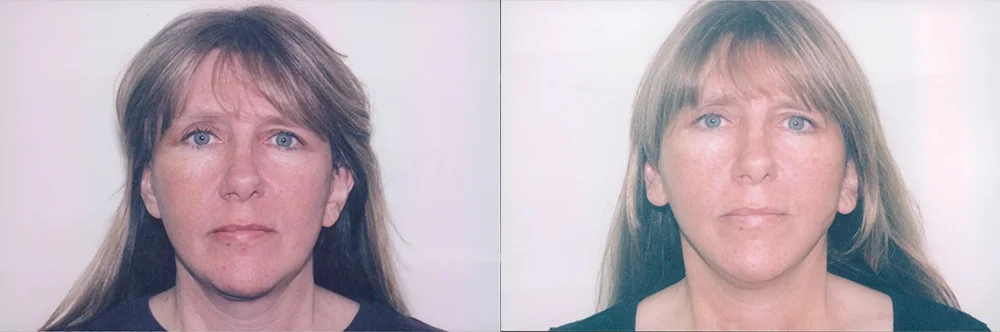 Real patient results in Newport Beach, CA Performed by Boris M. Ackerman MD