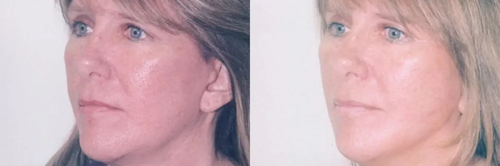 Real patient results in Newport Beach, CA Performed by Boris M. Ackerman MD