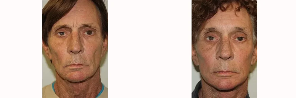 Real patient results in Newport Beach, CA Performed by Boris M. Ackerman MD