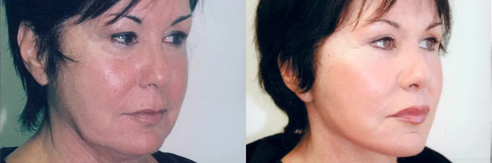 Real patient results in Newport Beach, CA Performed by Boris M. Ackerman MD