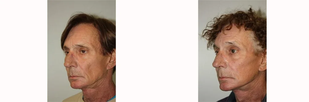 Real patient results in Newport Beach, CA Performed by Boris M. Ackerman MD