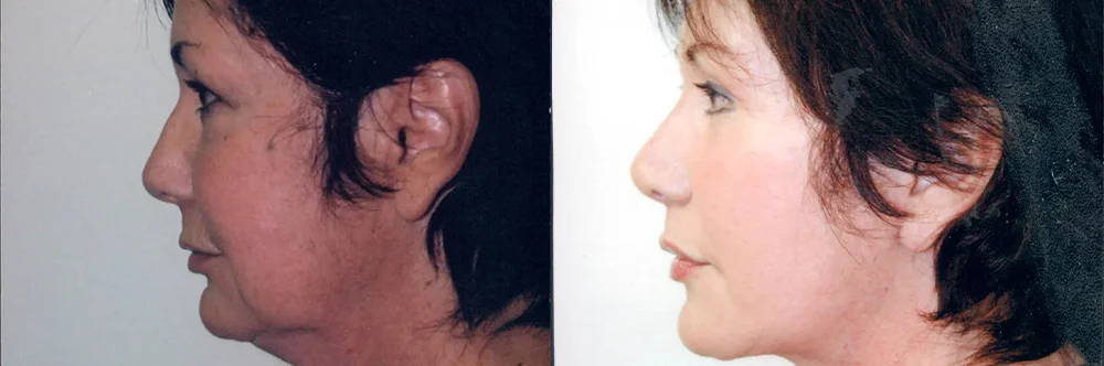 Real patient results in Newport Beach, CA Performed by Boris M. Ackerman MD