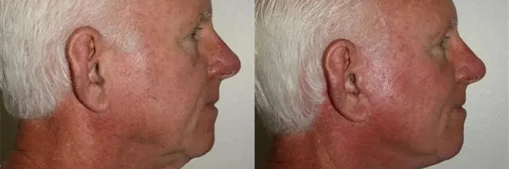 Real patient results in Newport Beach, CA Performed by Boris M. Ackerman MD