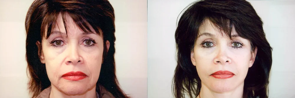Real patient results in Newport Beach, CA Performed by Boris M. Ackerman MD