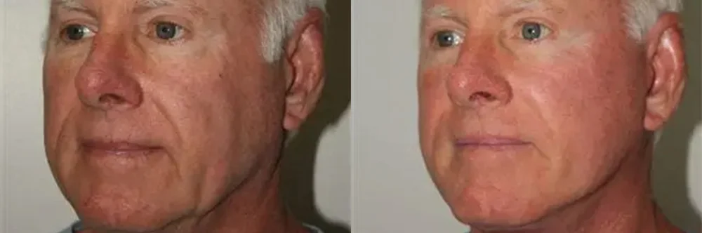 Real patient results in Newport Beach, CA Performed by Boris M. Ackerman MD