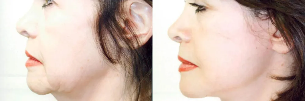 Real patient results in Newport Beach, CA Performed by Boris M. Ackerman MD