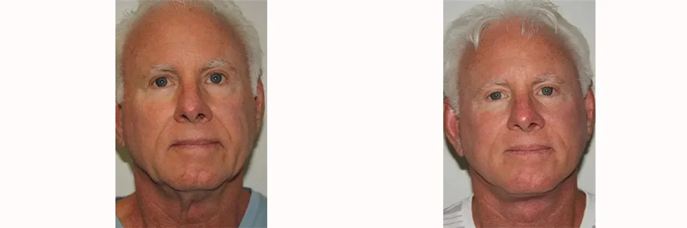 Real patient results in Newport Beach, CA Performed by Boris M. Ackerman MD