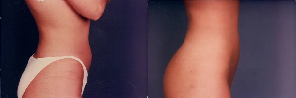 Real patient results in Newport Beach, CA Performed by Boris M. Ackerman MD