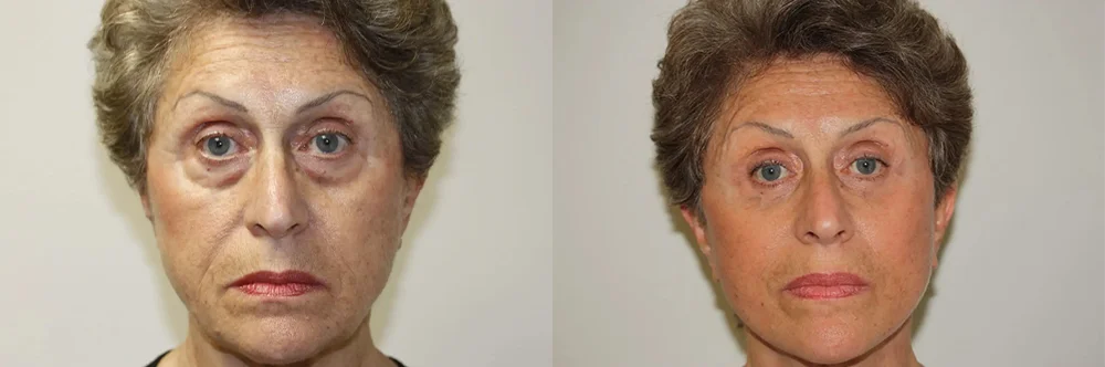 Real patient results in Newport Beach, CA Performed by Boris M. Ackerman MD