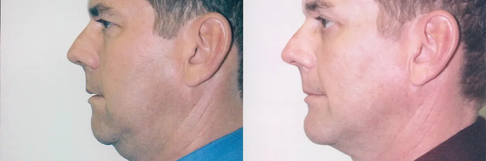 Real patient results in Newport Beach, CA Performed by Boris M. Ackerman MD