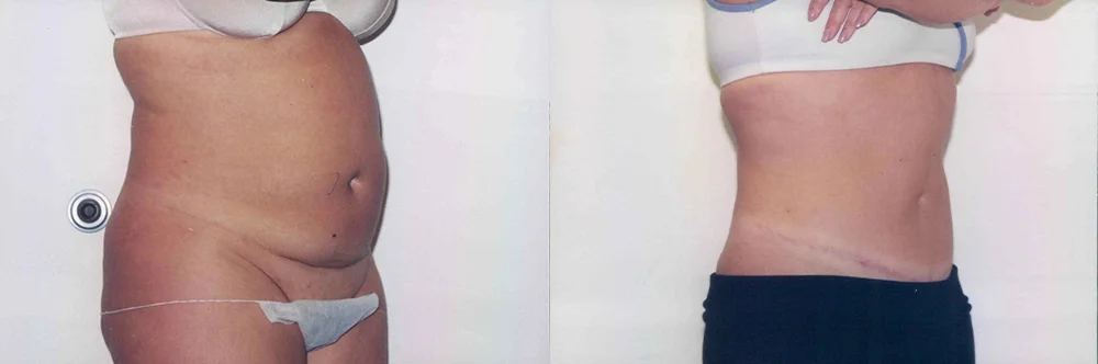 Real patient results in Newport Beach, CA Performed by Boris M. Ackerman MD