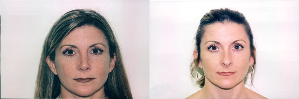 Real patient results in Newport Beach, CA Performed by Boris M. Ackerman MD