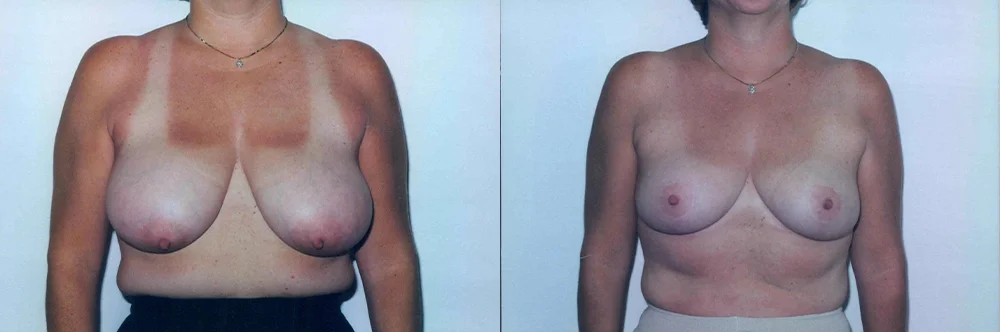 Real patient results in Newport Beach, CA Performed by Boris M. Ackerman MD
