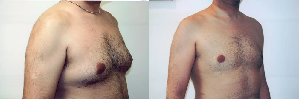 Real patient results in Newport Beach, CA Performed by Boris M. Ackerman MD