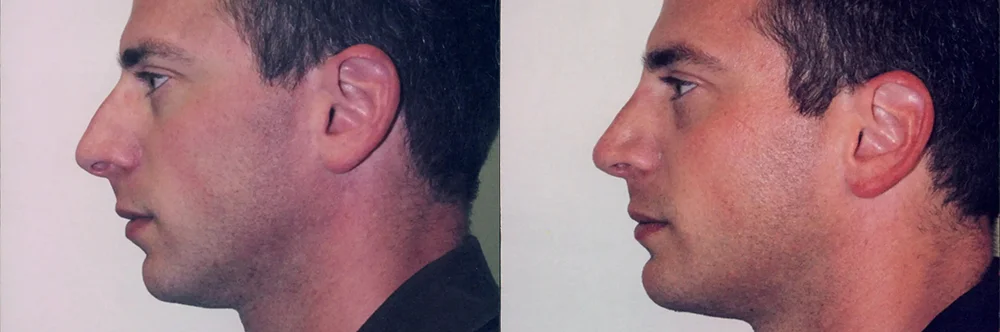 Real patient results in Newport Beach, CA Performed by Boris M. Ackerman MD