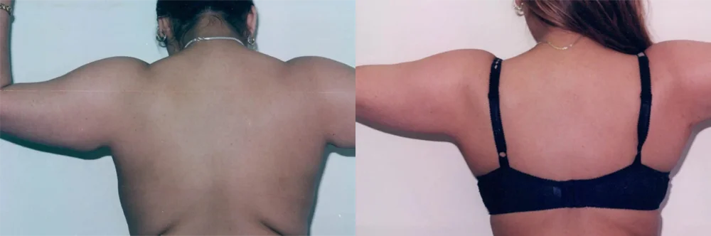 Real patient results in Newport Beach, CA Performed by Boris M. Ackerman MD