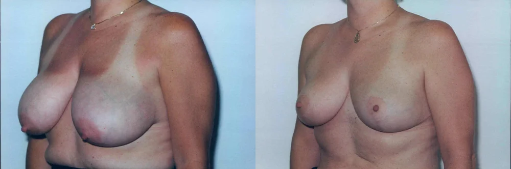 Real patient results in Newport Beach, CA Performed by Boris M. Ackerman MD