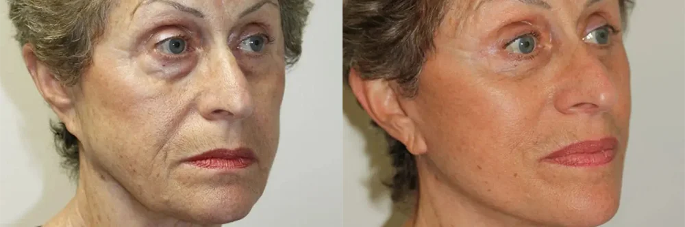 Real patient results in Newport Beach, CA Performed by Boris M. Ackerman MD