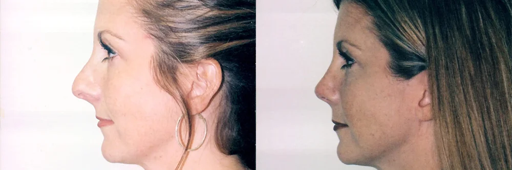 Real patient results in Newport Beach, CA Performed by Boris M. Ackerman MD