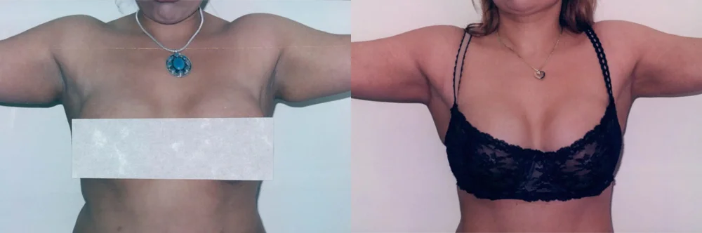 Real patient results in Newport Beach, CA Performed by Boris M. Ackerman MD
