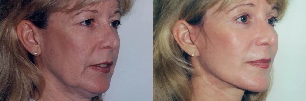 Real patient results in Newport Beach, CA Performed by Boris M. Ackerman MD