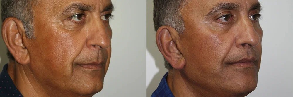 Real patient results in Newport Beach, CA Performed by Boris M. Ackerman MD