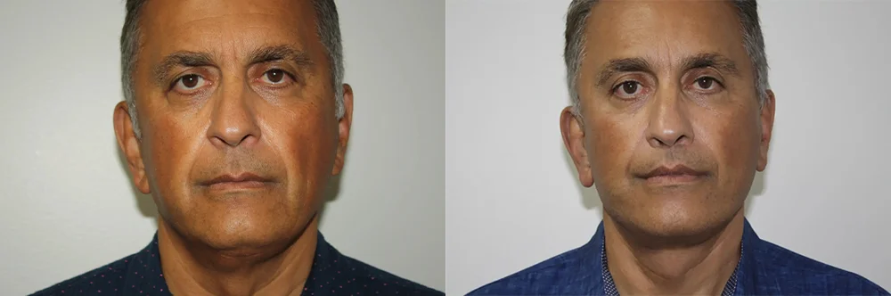 Real patient results in Newport Beach, CA Performed by Boris M. Ackerman MD