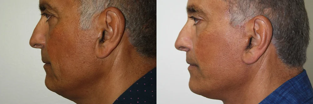 Real patient results in Newport Beach, CA Performed by Boris M. Ackerman MD