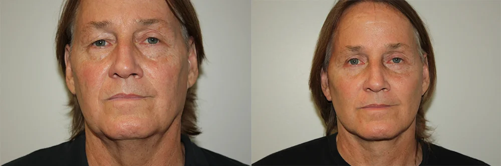 Real patient results in Newport Beach, CA Performed by Boris M. Ackerman MD