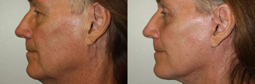 Real patient results in Newport Beach, CA Performed by Boris M. Ackerman MD