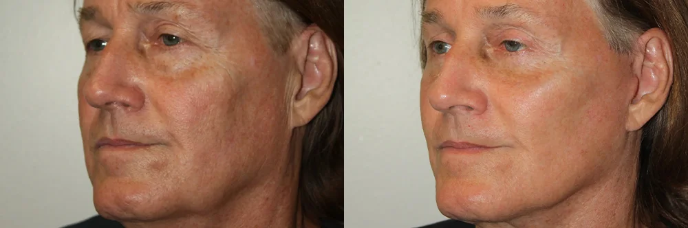 Real patient results in Newport Beach, CA Performed by Boris M. Ackerman MD
