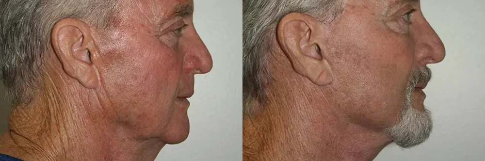 Real patient results in Newport Beach, CA Performed by Boris M. Ackerman MD