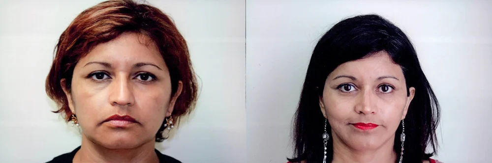 Real patient results in Newport Beach, CA Performed by Boris M. Ackerman MD