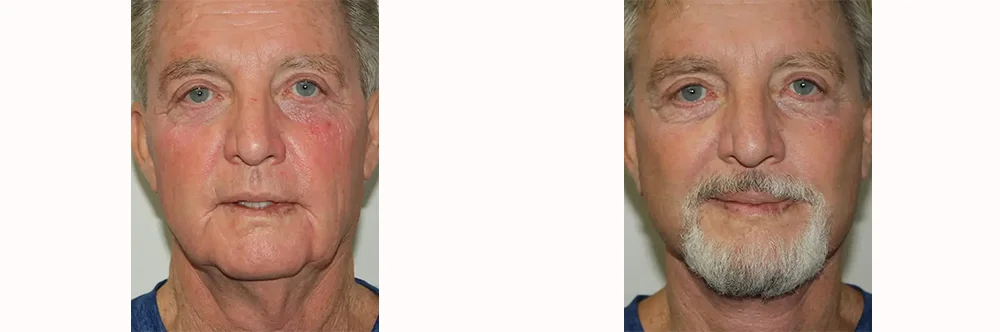 Real patient results in Newport Beach, CA Performed by Boris M. Ackerman MD