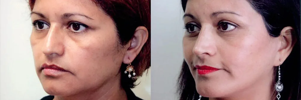 Real patient results in Newport Beach, CA Performed by Boris M. Ackerman MD