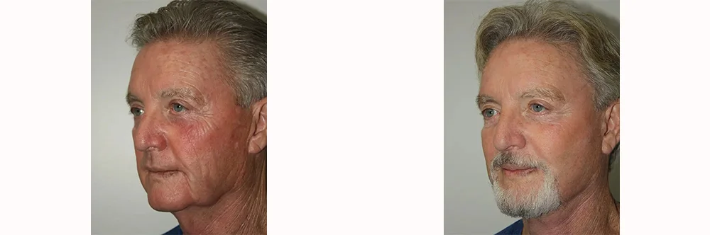 Real patient results in Newport Beach, CA Performed by Boris M. Ackerman MD