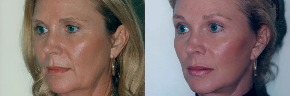 Real patient results in Newport Beach, CA Performed by Boris M. Ackerman MD