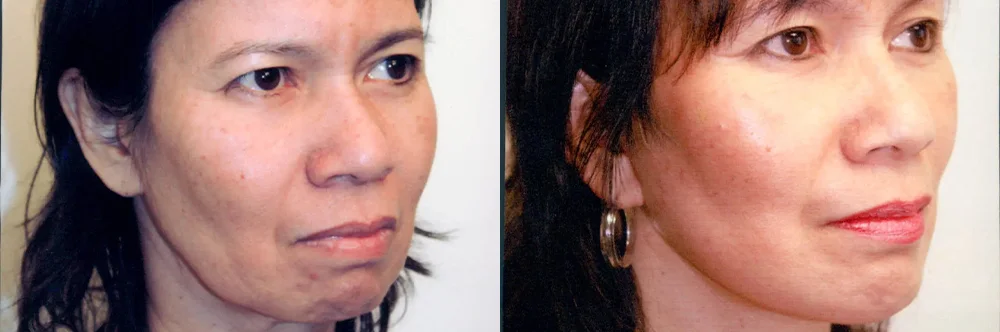 Real patient results in Newport Beach, CA Performed by Boris M. Ackerman MD