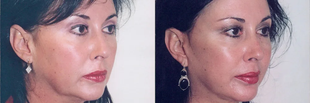 Real patient results in Newport Beach, CA Performed by Boris M. Ackerman MD