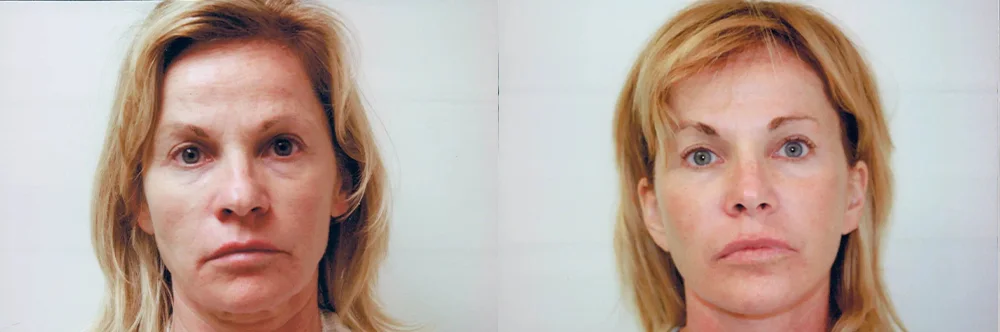 Real patient results in Newport Beach, CA Performed by Boris M. Ackerman MD
