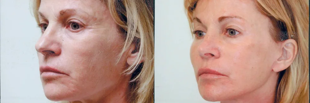 Real patient results in Newport Beach, CA Performed by Boris M. Ackerman MD