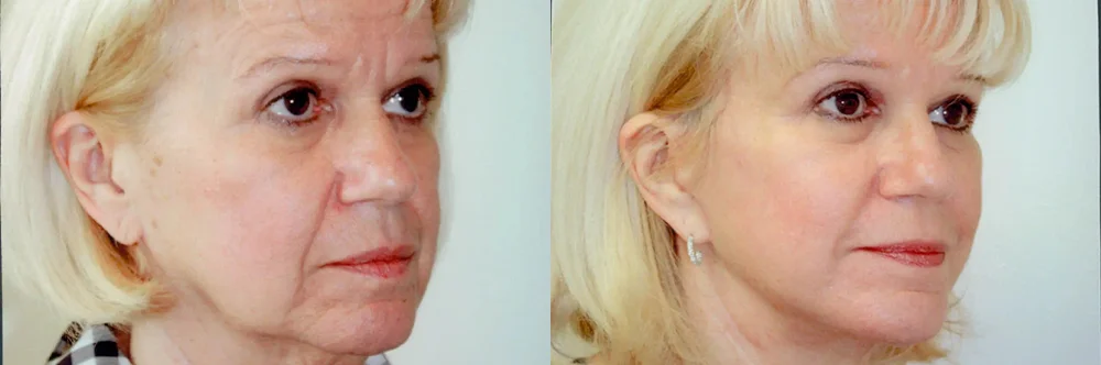 Real patient results in Newport Beach, CA Performed by Boris M. Ackerman MD