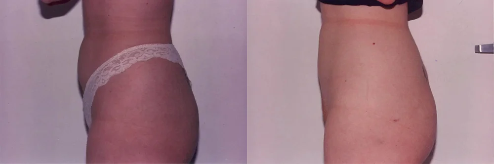 Real patient results in Newport Beach, CA Performed by Boris M. Ackerman MD