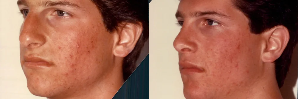 Real patient results in Newport Beach, CA Performed by Boris M. Ackerman MD