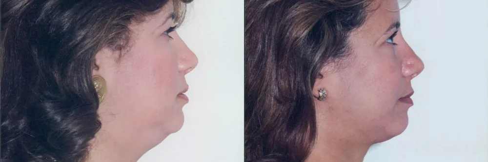Real patient results in Newport Beach, CA Performed by Boris M. Ackerman MD