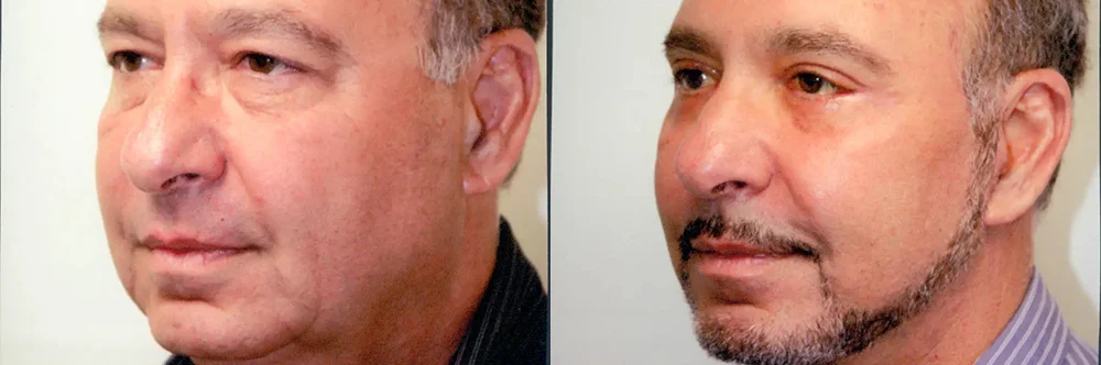 Real patient results in Newport Beach, CA Performed by Boris M. Ackerman MD