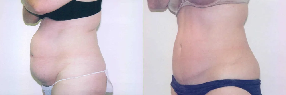 Real patient results in Newport Beach, CA Performed by Boris M. Ackerman MD