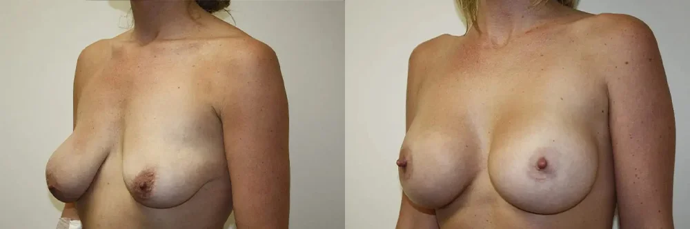 Real patient results in Newport Beach, CA Performed by Boris M. Ackerman MD