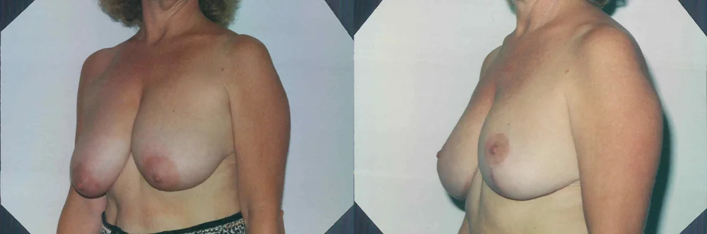 Real patient results in Newport Beach, CA Performed by Boris M. Ackerman MD